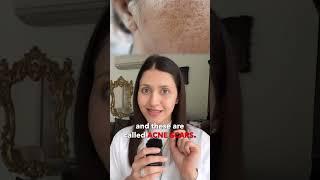 How to fix acne scars? || Dr. Jushya Sarin ||