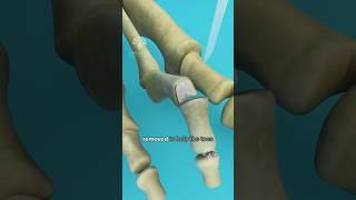 What is Hammer Toe and How to Fix It #shorts #viralvideo - Creativelearning3d