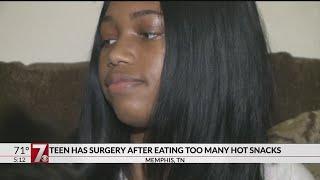 Teen has surgery after eating too many hot snacks