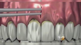 Dr. Max Gomez: Regrowing Gums