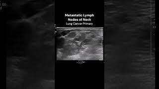 Neck Lymph Nodes  #ultrasound #imaging #cancer #cases