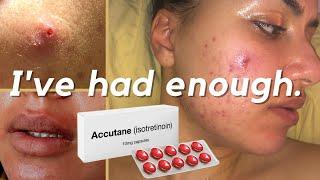 Why I'm Starting Accutane (Isotretinoin) For My Cystic Acne |40mg Accutane Journey #accutane  #acne