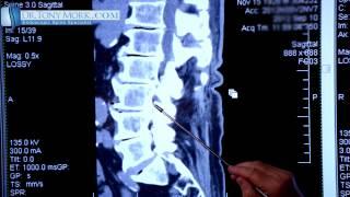 Spondylosis  by Dr. Tony Mork