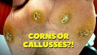 THICK, DEEP Seeded Corn and Callus Removal