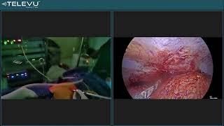 Innovative  technique for appendicular lump during laparoscopy