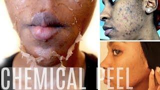 CHEMICAL PEEL! | Full Peeling Process |BEFORE & AFTER | How To Get Rid of Hyperpigmentation