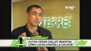 César Caillet se sometió a un implante de cabello