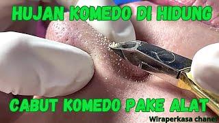 Hujan Komedo Di Hidung Cabut Komedo Pakai Alat