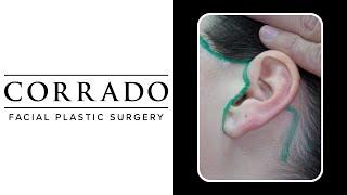 Performing Facelift Surgery Without Visible Scars | Dr. Anthony Corrado