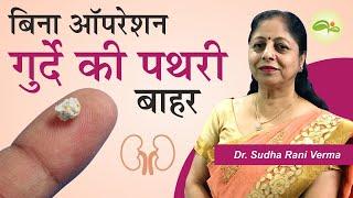 Kidney stone treatment without surgery | किडनी स्टोन का घरेलू इलाज | पथरी कैसे निकाले | Aayu Shakti