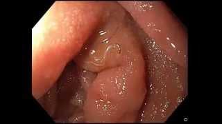 Hookworm movie by Gastroenterologist Dr John Croese fromThe Prince Charles Hospital