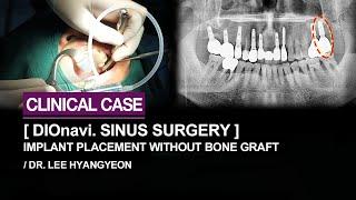 Implant placement and sinus augmentation in the second molar