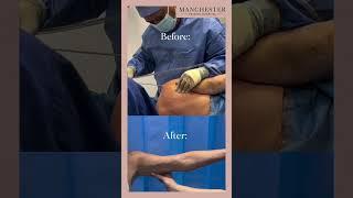 Debra’s Arm Vaser Liposuction Story 7-Week Updates | Transformation to Slim, Pain-Free Arms