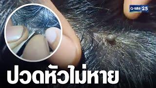 ปวดหัวอย่าไว้ใจ! เห็บหมาขึ้นหัวดูดเลือด | เกาะข่าวเที่ยง | GMM25