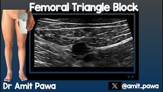 Femoral Triangle Block