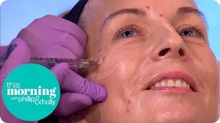 Woman Is Injected With Botox and Fillers Live on This Morning | This Morning