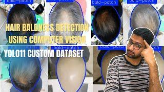 YOLO11: Custom Dataset for Hair Baldness Detection Using Computer Vision