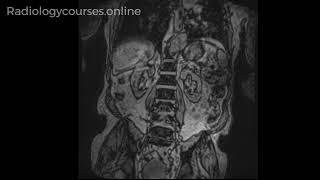 Don't ever forget to review localizer images - aortic aneurysm is sitting there