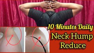 Top 10 Exercise To Reduce Neck Hump With 15 Days At Home|  #neckhump  #yogasouvik