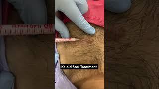 Effective Keloid Scar Treatment Injection | Keloid Removal Treatment | Skinaa Clinic #viral #short