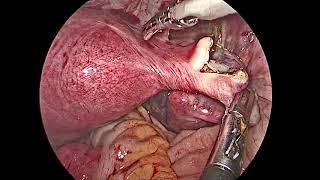 Laparoscopic Right  Salpingectomy