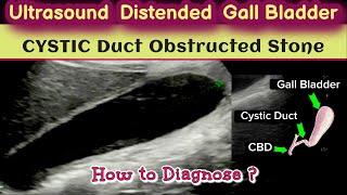 Ultrasound Distended Gall bladder - Cystic Duct Stone | How to Diagnose