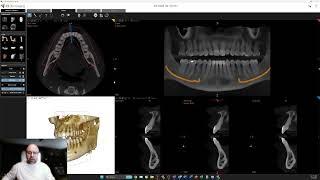 Nerve Tracing Video   Long