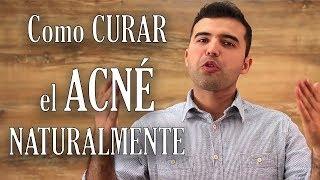 Como Curar el Acne Naturalmente