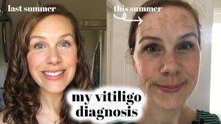 My Vitiligo Diagnosis