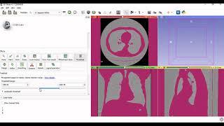 3D Slicer Demonstration- CT Scan/MRI to 3D Model - .stl file