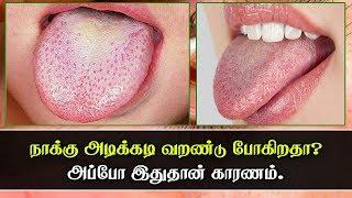 Dry Mouth - Causes, Symptoms Treatments & More | நாக்கு அடிக்கடி வறண்டு போகுதா? | AzhaghuTamil