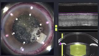 Cirurgia de Catarata a Laser HOB Brasilia https://www.youtube.com/watch?v=ilSqcySDs50