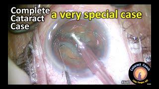 Complete Cataract Case: a very special case for cataract surgery