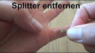 Nasty Splinter Removal -Holzsplitter entfernen Splitter in Hand entfernen Pinzette Splitter ziehen