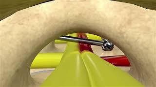 3D Medical Animation - Minimally Invasive Spinal Stenosis Decompression