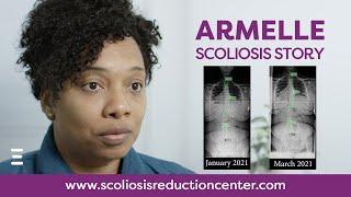 Adult Scoliosis Treatment Without Surgery: Armelle's Story