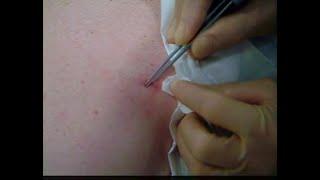 Skin surgery - shave excision 2