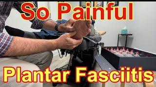 Extremely Successful  Plantar Fasciits Treatment