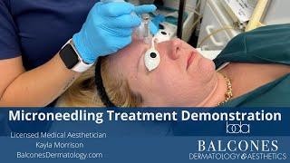 Microneedling Teatment Demo | Balcones Dermatology & Aesthetics |Austin, TX | Ph:512-459-4869