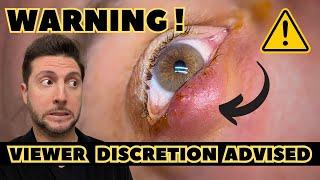 Eyelid Bump - Let's Drain It!