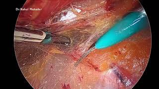 eTEP bilateral inguinal hernia repair