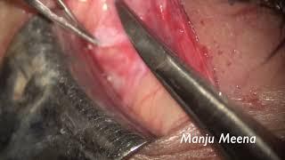 Lacrimal Gland Biopsy by Dr Manju Meena