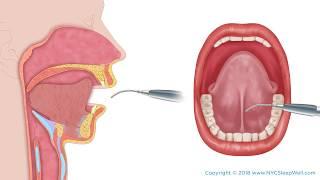 Frenectomy (Tongue Tie) Procedure