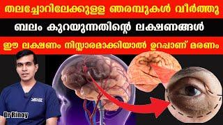 തലച്ചോറിലേക്കുള്ള ഞരമ്പുകൾ വീർത്തു ബലം കുറയുന്നതിന്റെ ലക്ഷണങ്ങൾ .ഈ ലക്ഷണം നിസ്സാരമാക്കിയാൽ /Dr Rinoy