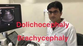 Sonography/ Dolichocephaly and Brachycephaly
