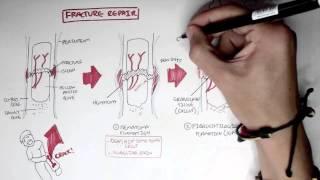 Bone Fracture - Types, Fracture Repair and Osteomyelitis