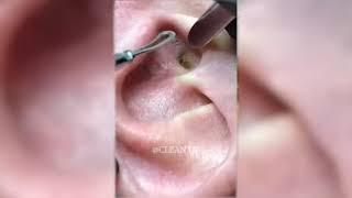 Ear Blackhead Removal 2 #blackheads #blackheadremoval #subscribe