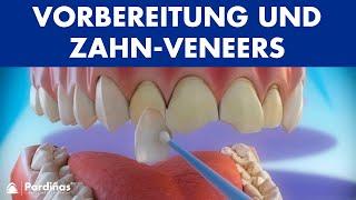 Veneers – Vorbereitung und Zahn-Veneers Stellung ©