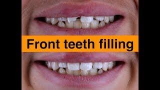 Front teeth filling