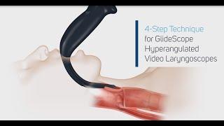 How to Intubate Using a GlideScope® Video Laryngoscope in 4 Steps